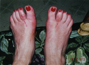 bunions after