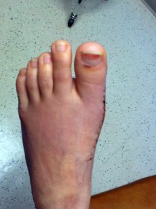 This is a photo of a patient's foot that after surgery to remove bunions. 