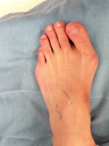 This is a before photo of a patient's foot with bunions.